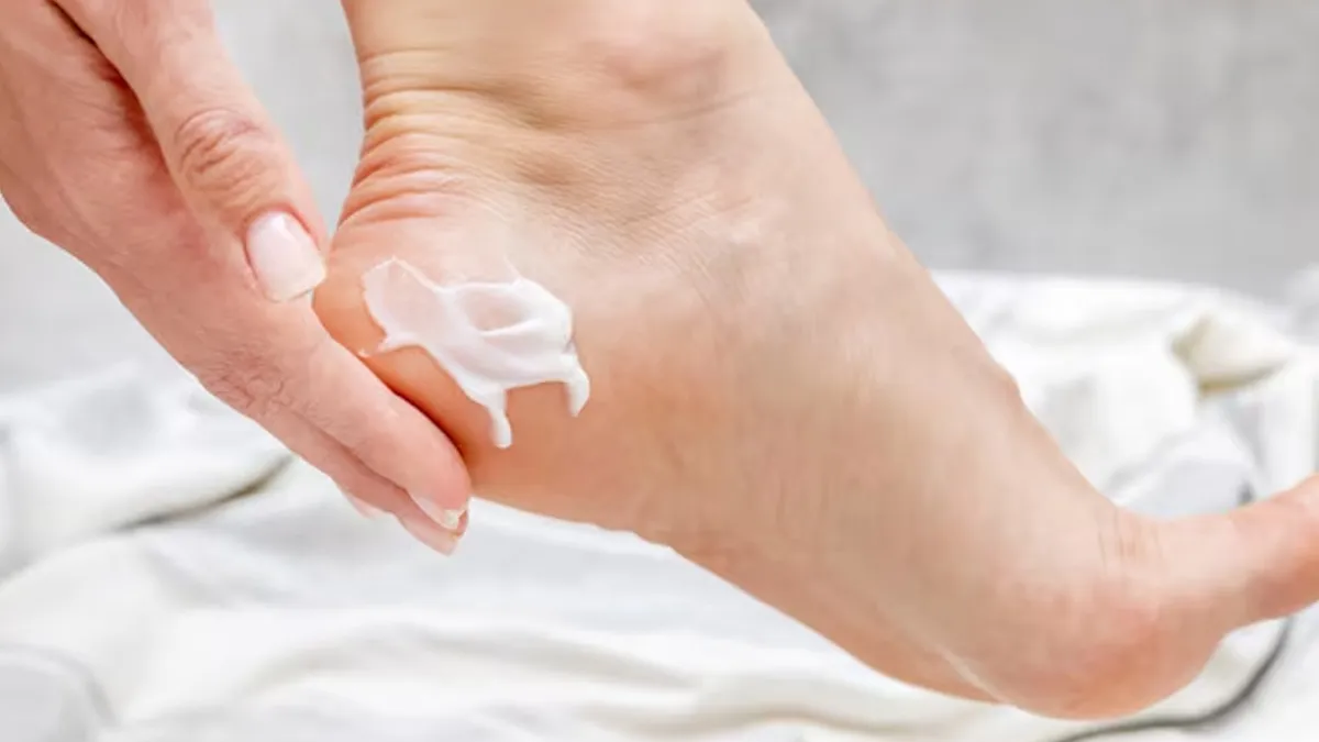 Why Cracked Heels Persist