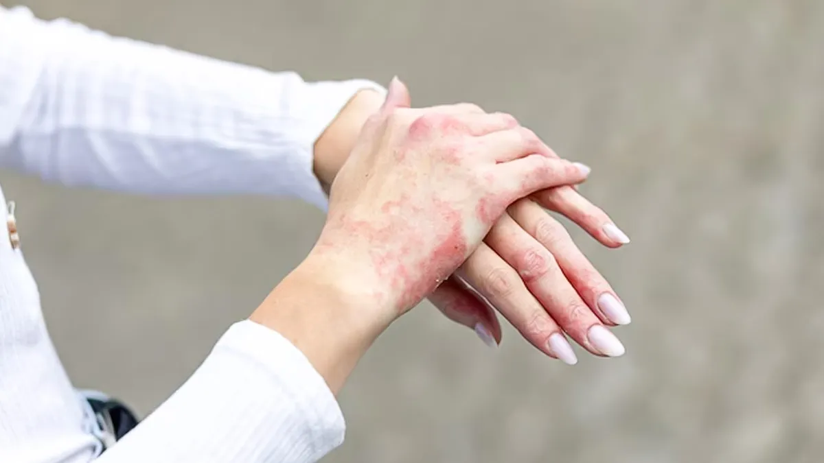 Does Stress Trigger Eczema