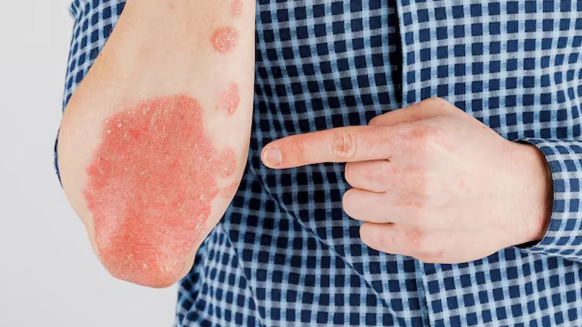 How Does Stress Trigger Eczema
