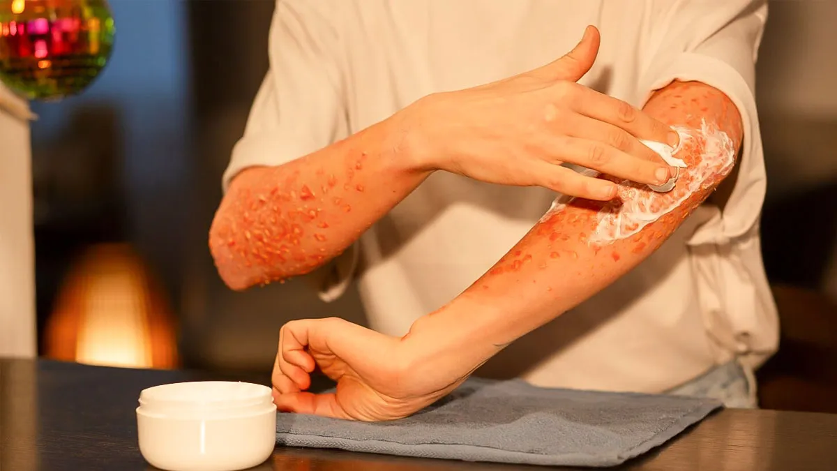 is psoriasis contagious