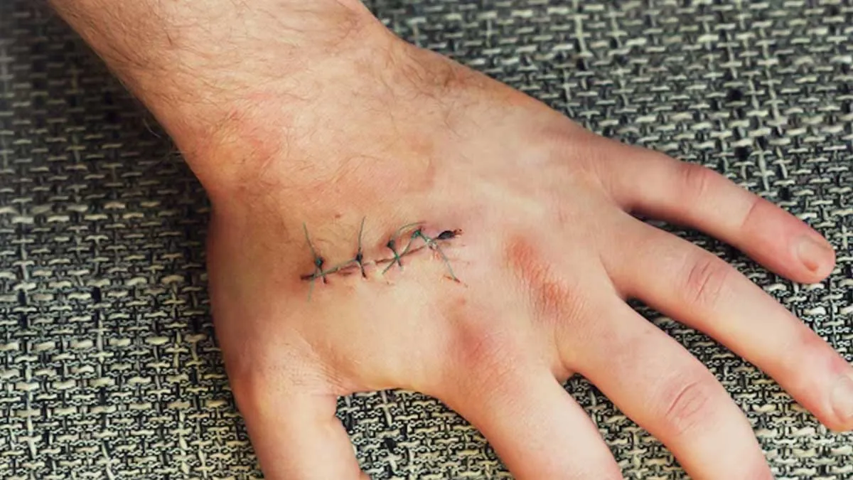 Tips-to-Take-Care-of-Stitches