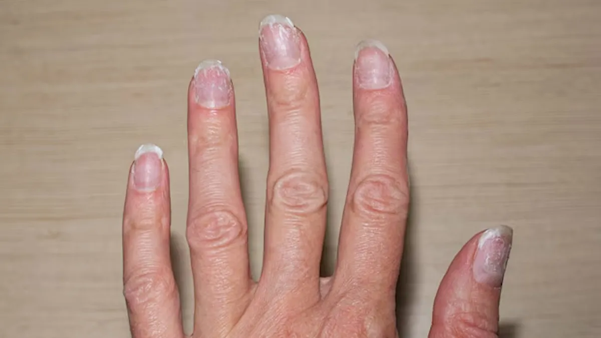 Warning Signs Of nail Psoriasis