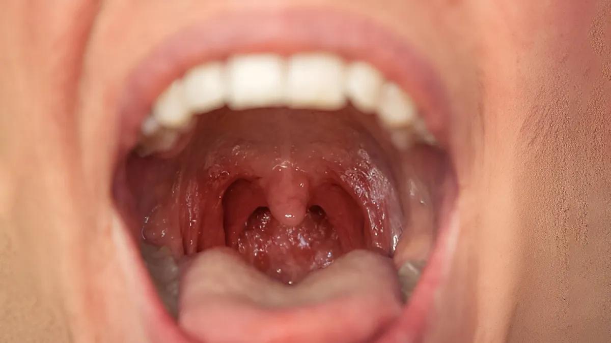 recuurent-tonsillitis-causes-treatment