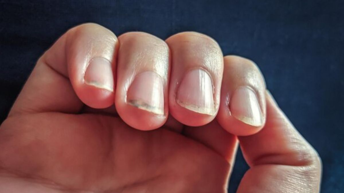 unhealthy-nails-body-disease