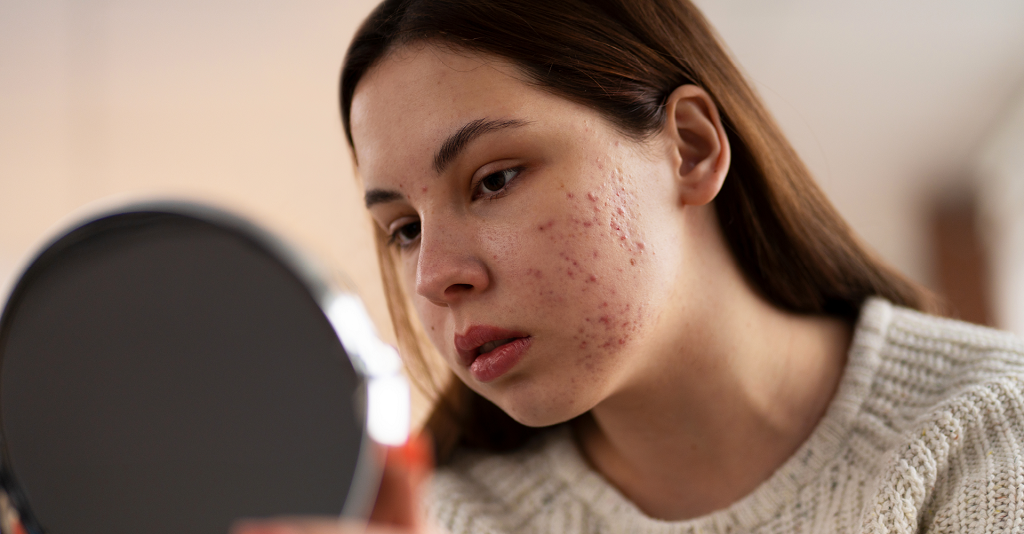 Period Acne: மாதவிடாய்க்கு முன் முகத்தில் பருக்கள் தோன்றுவது ஏன்? காரணம் இதோ!