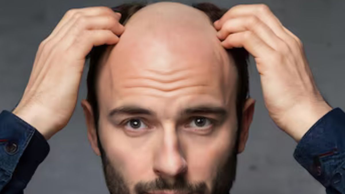 male baldness