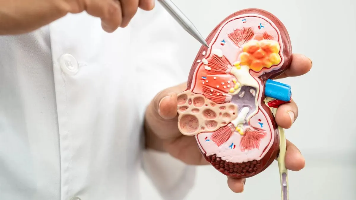 kidney stone: சிறுநீரக கற்கள் புற்றுநோயை உண்டாக்குமா? நிபுணர்கள் கூறுவது என்ன?
