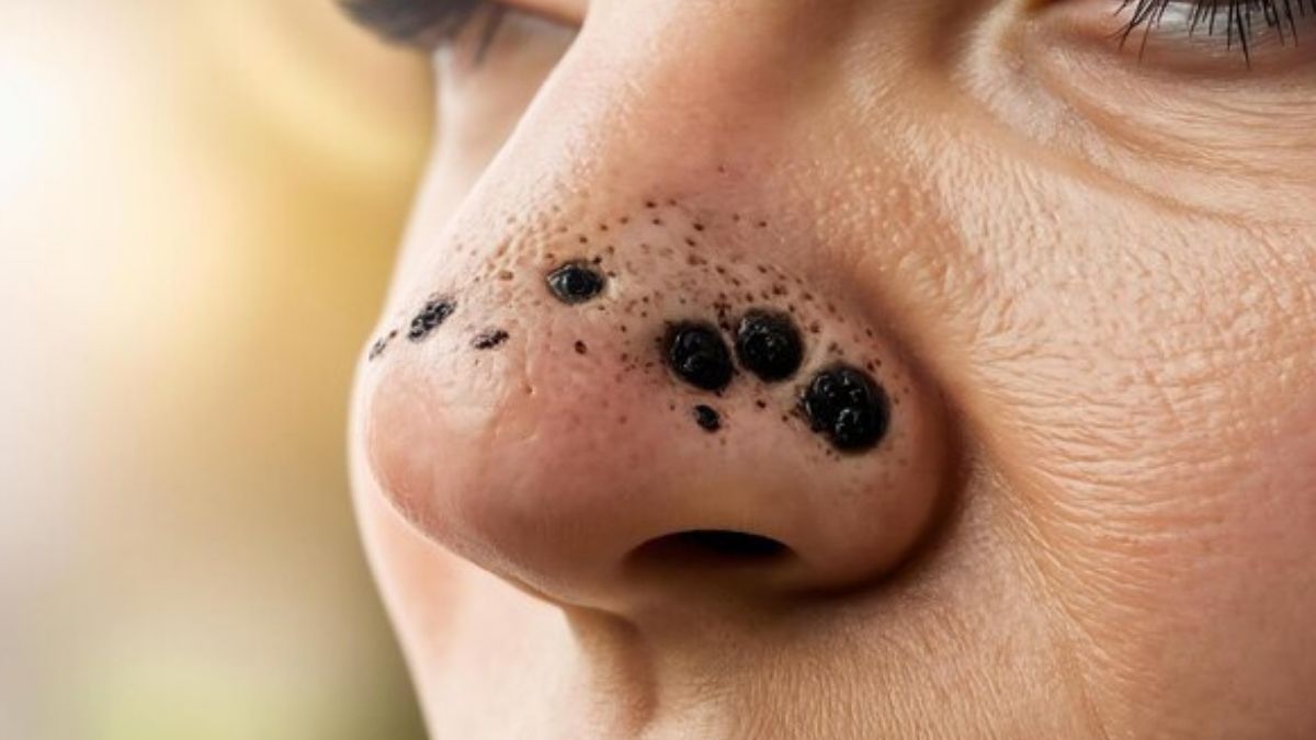 skin pore hole home remedy