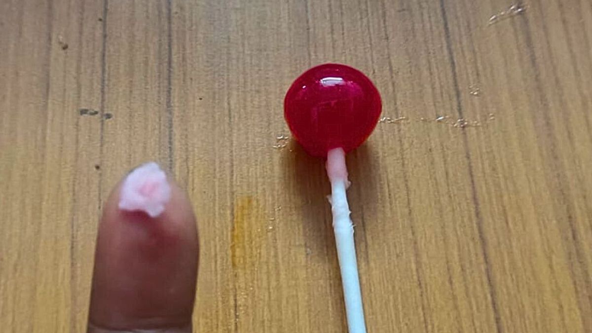 lollipop-side-effects