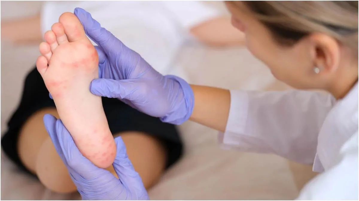 HFMD Disease: குழந்தைகளை அதிகம் தாக்கும் HFMD தொற்று; அறிகுறிகள் மற்றும் தடுப்பு நடவடிக்கை இங்கே!