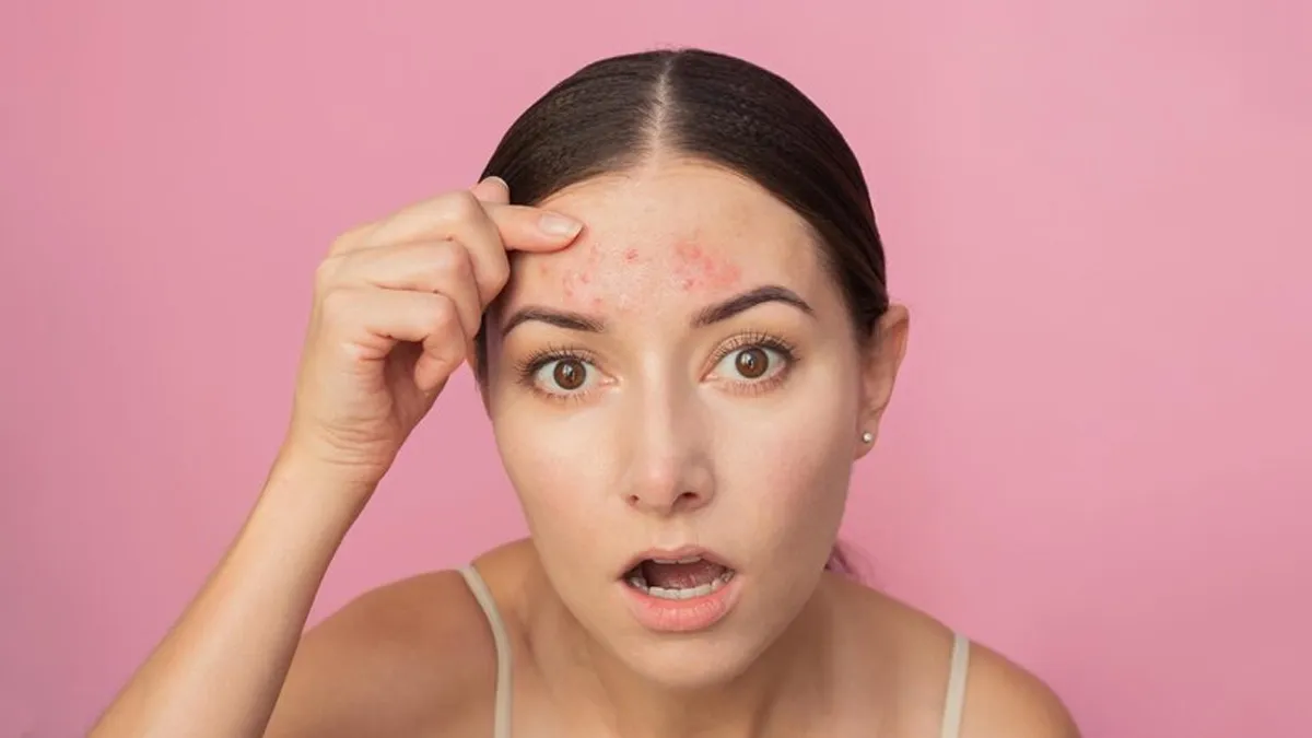 Forehead Acne: உங்களுக்கு நெற்றியில் மட்டும் பரு வருதா? அப்போ இந்த வீட்டு வைத்தியத்தை செய்யுங்க!