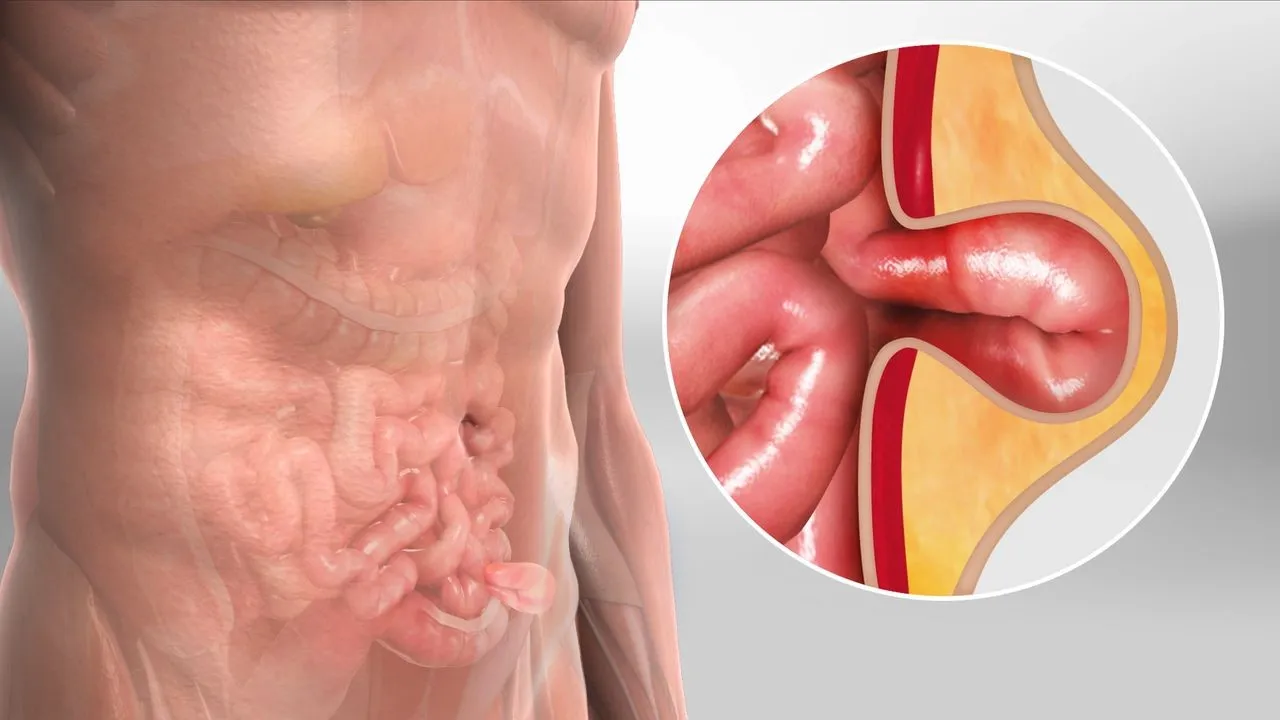 Hernias in Men: பெரும்பாலான ஆண்கள் ஏன் குடலிறக்க பிரச்சனைகளால் பாதிக்கப்படுகிறார்கள்?