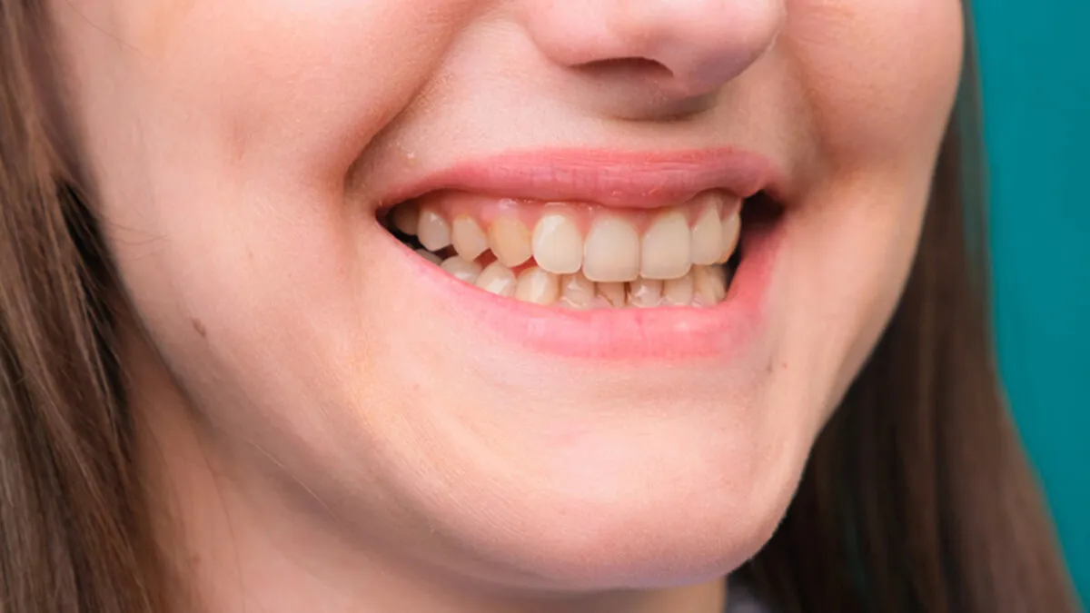 Causes of Yellow Teeth: ஒரு நாளைக்கு இரண்டு முறை பல் துலக்கினாலும் பற்கள் மஞ்சள் நிறமாக மாறும் தெரியுமா?