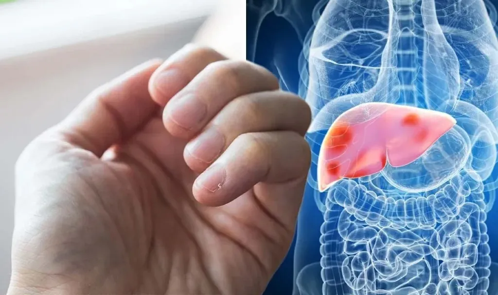 Liver Health:கல்லீரல் ஆரோக்கியத்தை நகத்தின் நிறத்தை வைச்சி தெரிஞ்சிக்கலாம் வாங்க... இந்த 5 அறிகுறிகள் ஆபத்தானது!