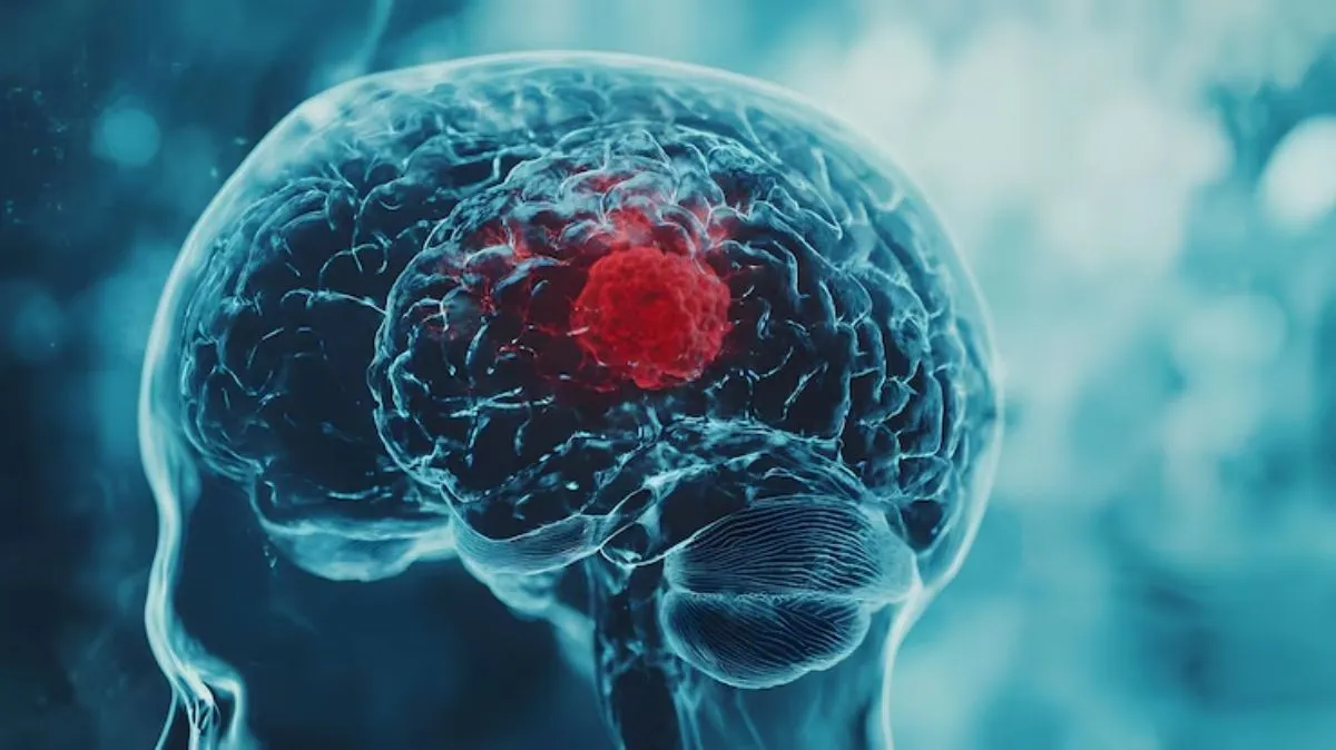 யாருக்கெல்லாம் மூளைக் கட்டி ஏற்படும் தெரியுமா.? இது நினைவாற்றல் இழப்பை ஏற்படுத்துமா.? விளக்கம் இங்கே..