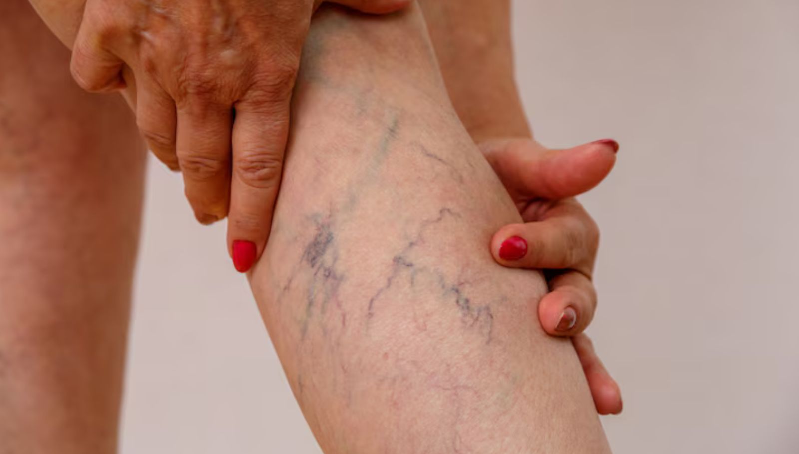 vericos-veins-home-remedy