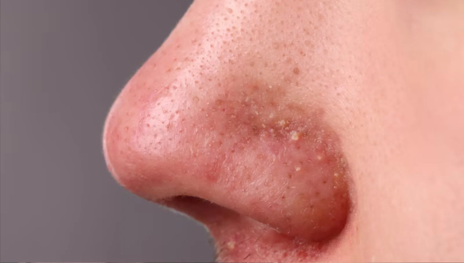 Nose BlackHeads: மூக்கின் மேல் உள்ள கரும்புள்ளிகள், துளைகள் தடம் தெரியாமல் மறைய வீட்டு வைத்தியம்!
