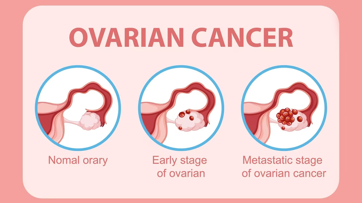 what-is-the-main-cause-of-ovarian-cancer-02