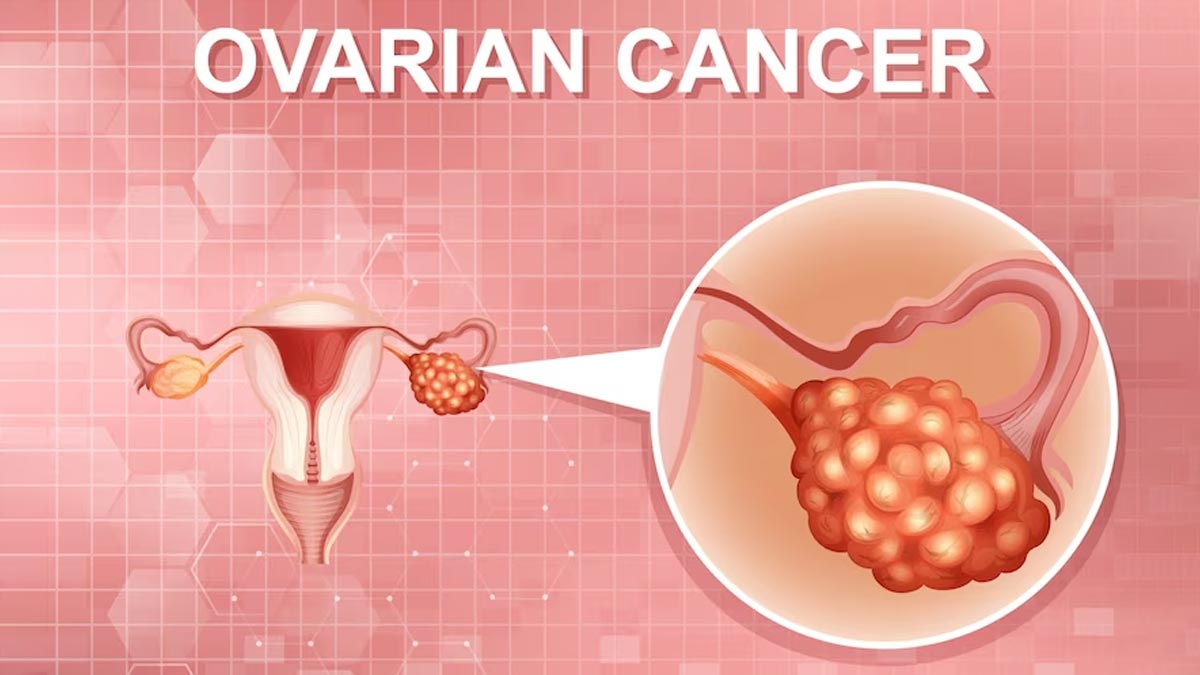 what-is-the-main-cause-of-ovarian-cancer-main