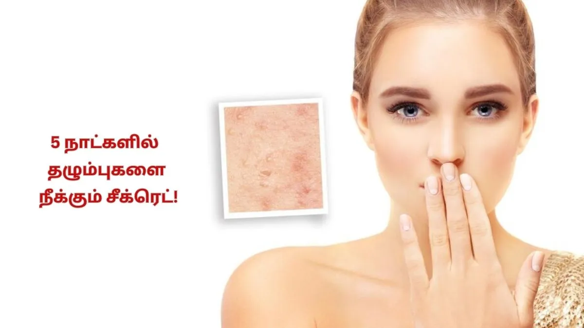 Scar Removal: முகத்தின் அழகை கெடுக்கும் தழும்புகள்.. நொடியில் மறைய சூப்பர் வீட்டு வைத்தியம்.!