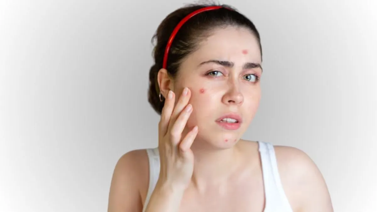 என்ன செய்தாலும் முகப்பரு போகவில்லையா? அதற்கான காரணங்கள் இதோ.. முகப்பருவைத் தடுக்க மருத்துவர் தரும் டிப்ஸ்