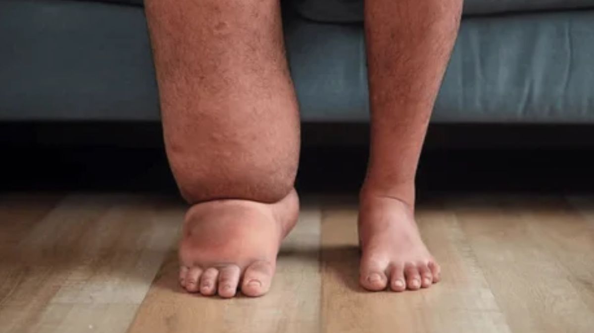 மழைக்காலத்தில் யானைக்கால் நோயிலிருந்து பாதுகாக்க 7 முக்கிய வழிகள்.. மருத்துவர்கள் எச்சரிக்கை..