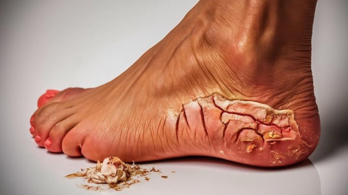 பித்த வெடிப்பு வராமல் தடுக்க சித்த மருத்துவர் சிவராமன் சொன்ன முக்கிய வழிமுறைகள்!