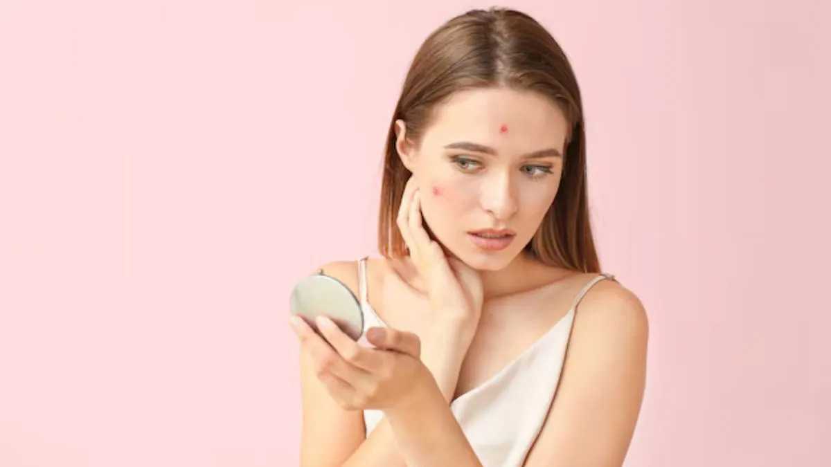 முகப்பரு என்ன செய்தாலும் போகலையா? உடனே மறைய காலையில் நீங்க செய்ய வேண்டிய 2 பழக்கங்கள்