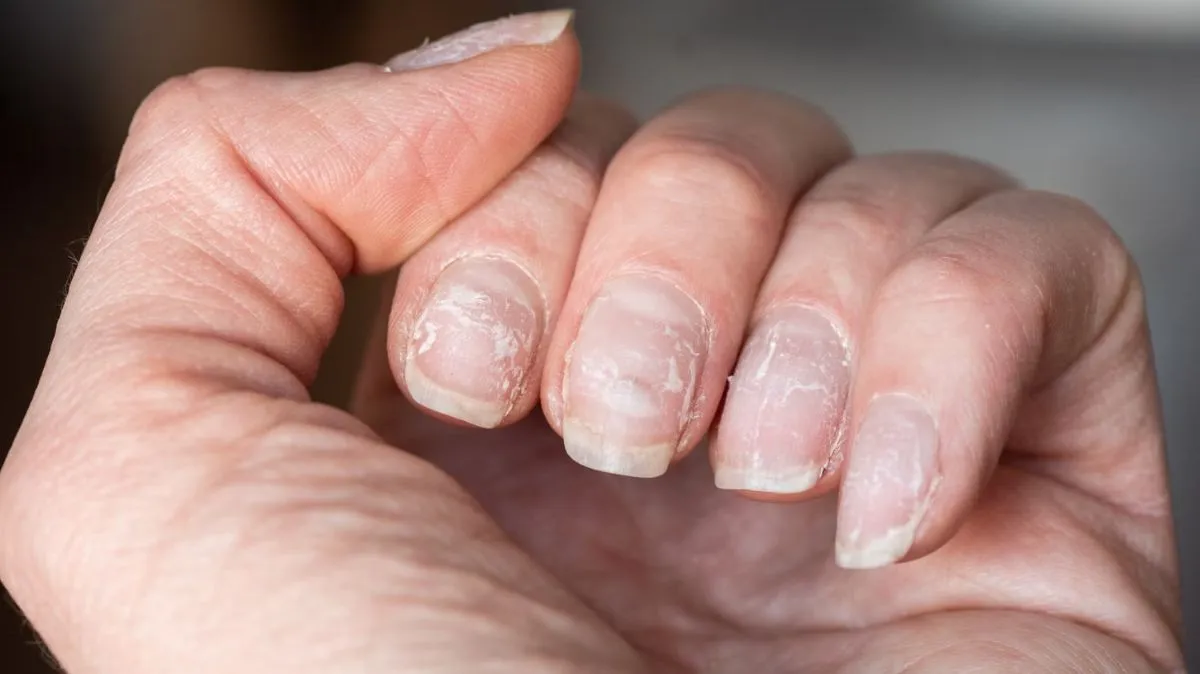 நகத்தில் தெரியும் அறிகுறி.. லேஸ்ல விட்றாதீங்க மக்களே.. மருத்துவர் எச்சரிக்கை.!