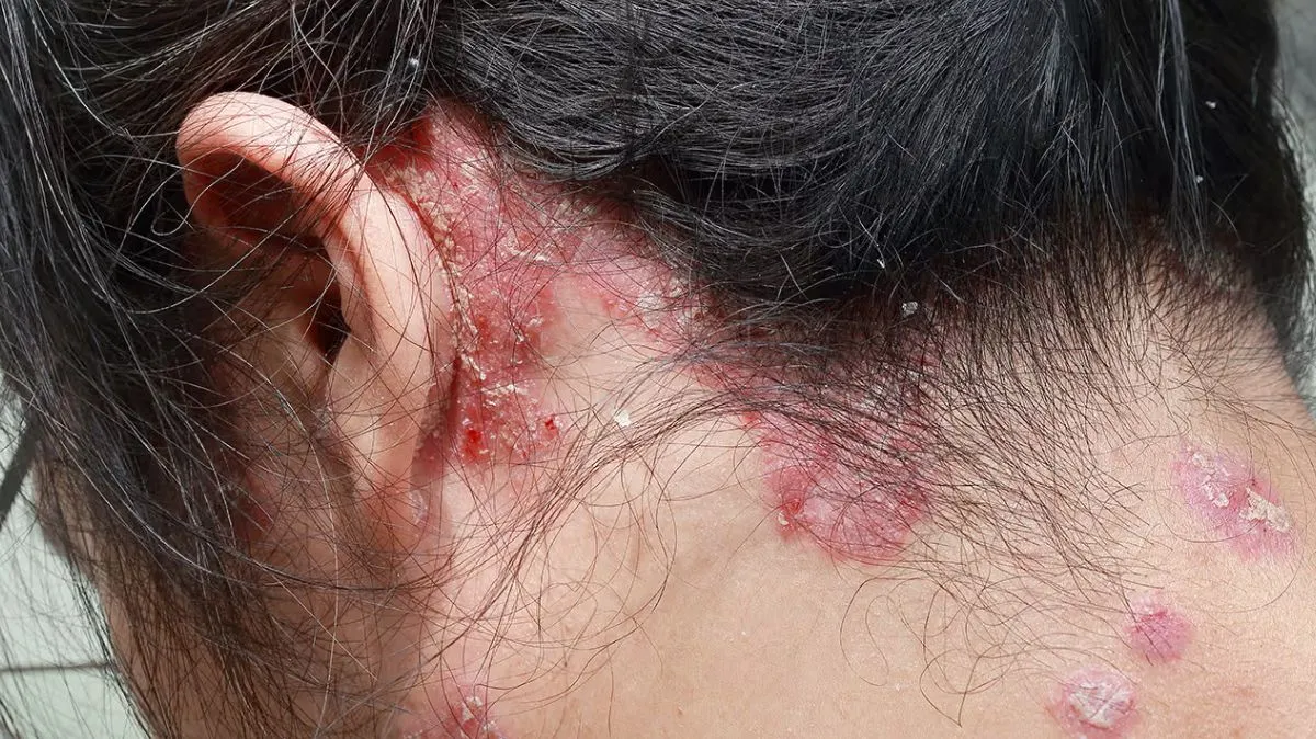 சொரியாசிஸ் முதல் தீராத பொடுகு வரை.. சித்த மருத்துவம் கூறும் நீண்டகால சரும நோய்களுக்கு இயற்கை தீர்வுகள்.!