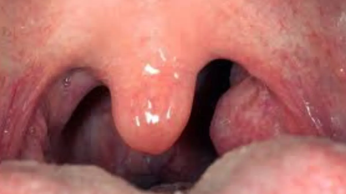 டான்சில் பிரச்சனையை வீட்டிலேயே கட்டுப்படுத்த 5 அட்டகாச டிப்ஸ்!