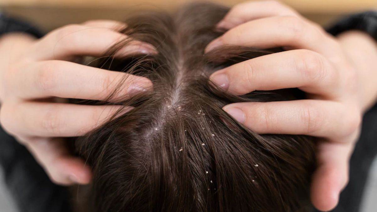 Dandruff Treatment: பொடுகு பிரச்சனையில் இருந்து விடுபட இந்த 3 எளிய வழிகளை பின்பற்றுங்கள்!