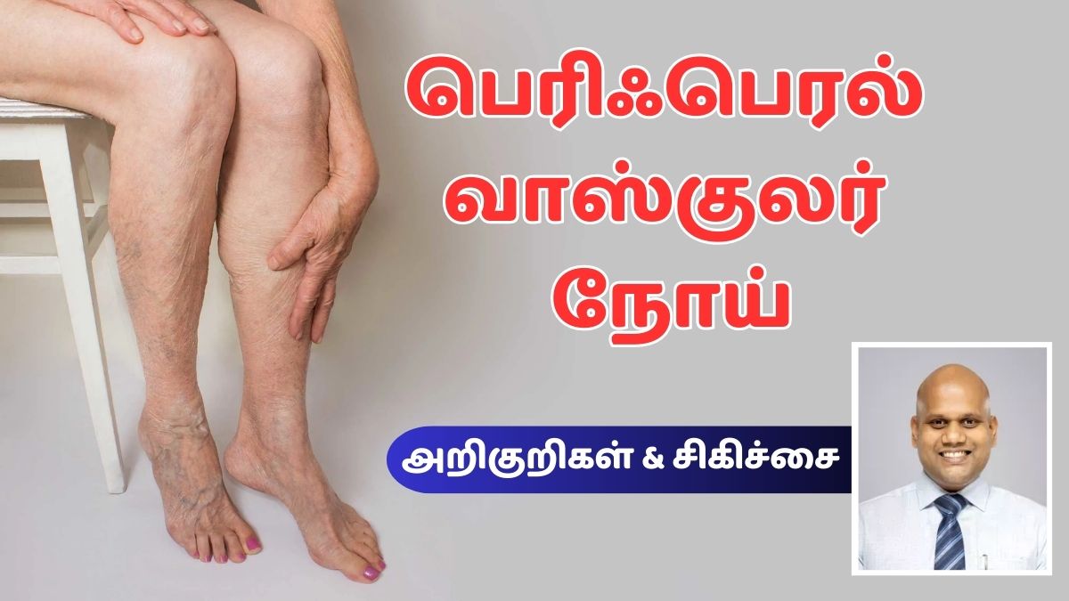 Peripheral vascular disease: பெரிஃபெரல் வாஸ்குலர் நோயின் அறிகுறி (ம) சிகிச்சை முறைகள் என்ன?