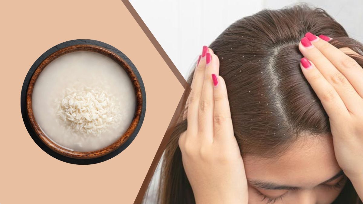 Rice Water for Dandruff பொடுகு தொல்லை நீங்க அரிசி கழுவிய நீரை இப்படி