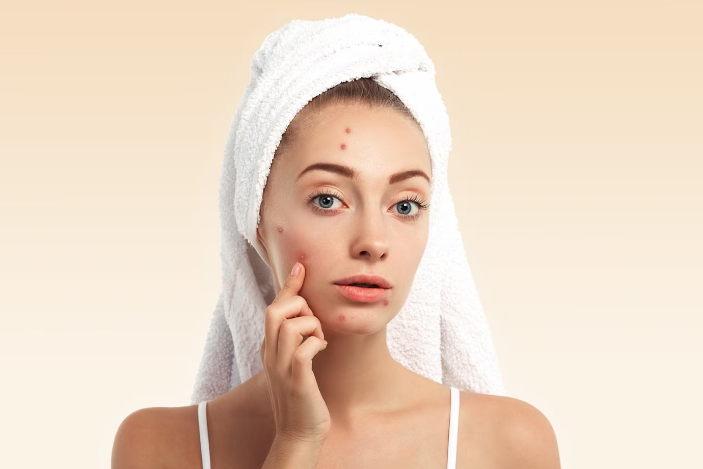 Anti-Acne Diet: முகப்பருவால் அவதியா? அழகான சருமத்தை பெற இவற்றை சாப்பிடுங்க!