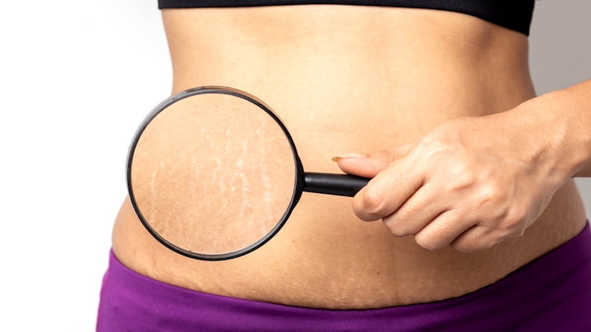 Stretch Marks Remedies: ஸ்ட்ரெட்ச் மார்க்ஸ் மறைய 'இந்த' வீட்டு வைத்தியங்கள ட்ரை பண்ணுங்க!