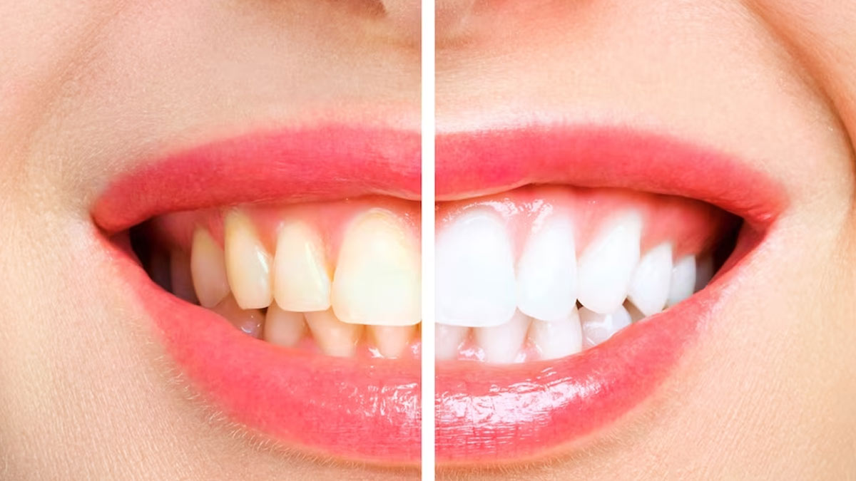 Teeth Whitening Tips: மஞ்சள் நிற பற்கள் வெண்மையாக மாற இதை சாப்பிட்டாலே போதும்!