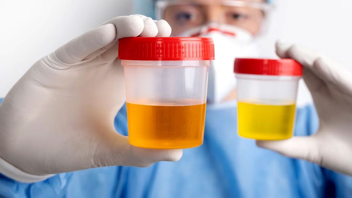 Yellow Urine: சிறுநீர் மஞ்சள் நிறத்தில் இருக்க காரணம் என்ன தெரியுமா?