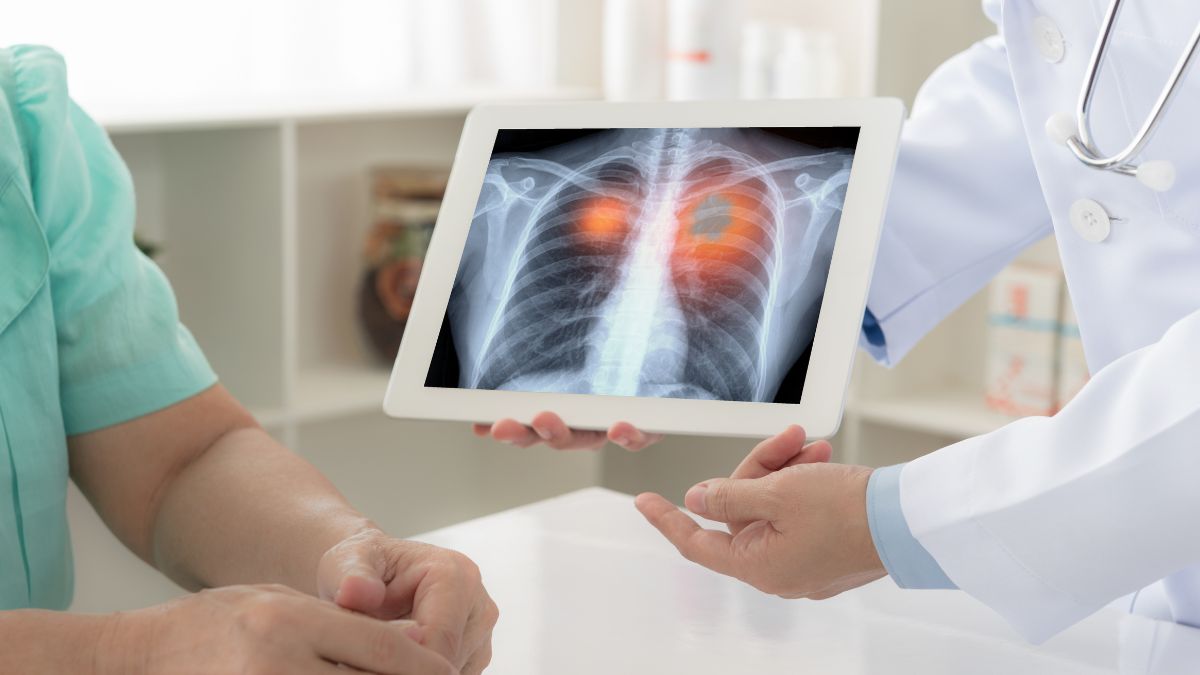 World Lung Cancer Day 2023 : நுரையீரல் புற்றுநோயில் இருந்து உங்களை பாதுகாப்பது எப்படி?