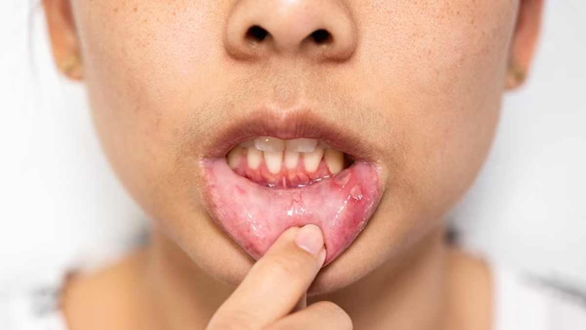 Child Mouth Ulcer: குழந்தைகளுக்கு வாய்ப்புண் ஏற்படுவதற்கான காரணங்களும் அறிகுறிகளும்