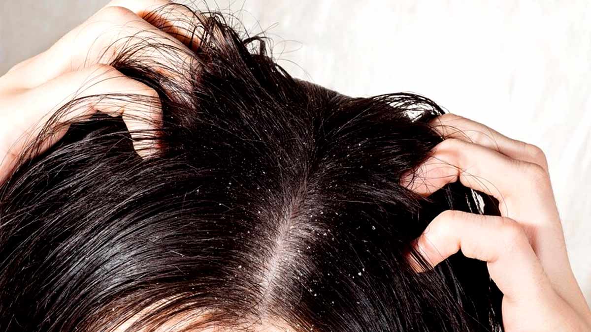 Dandruff Home Remedies: பொடுகு பிரச்சனையை சாதாரணமாக எடுக்க வேண்டாம்!