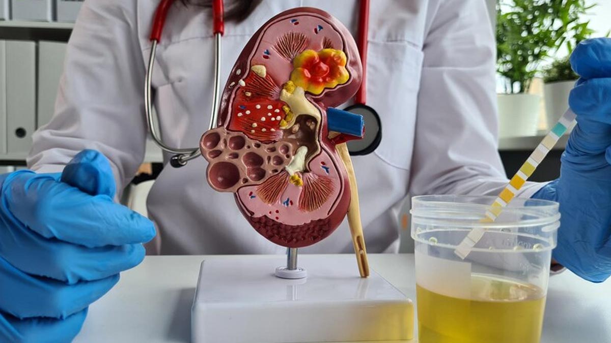 Kidney Stones Symptoms: சிறுநீரகக் கற்கள் இருப்பதற்கான ஆரம்ப கால அறிகுறிகள்