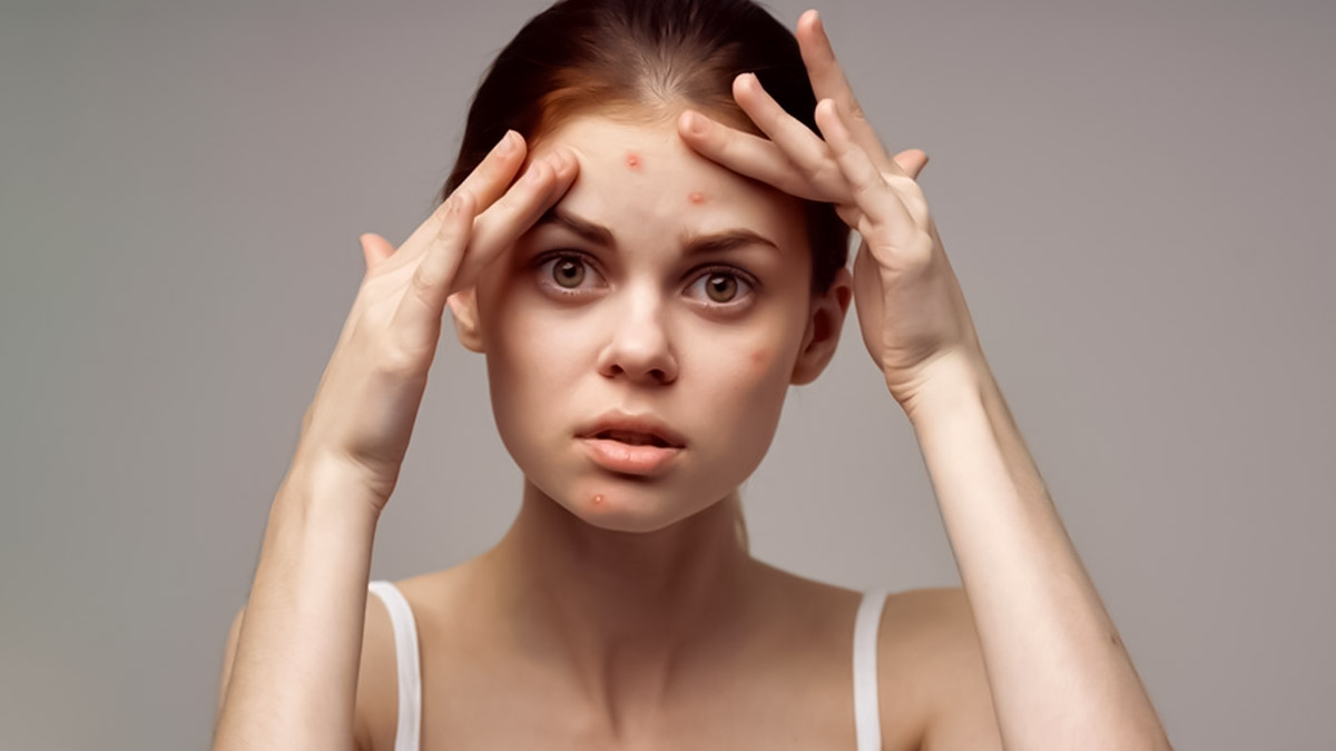 Forehead Acne: நெற்றி பருக்கள் ஏற்பட காரணம் என்ன? தடுப்பு முறை இதோ!