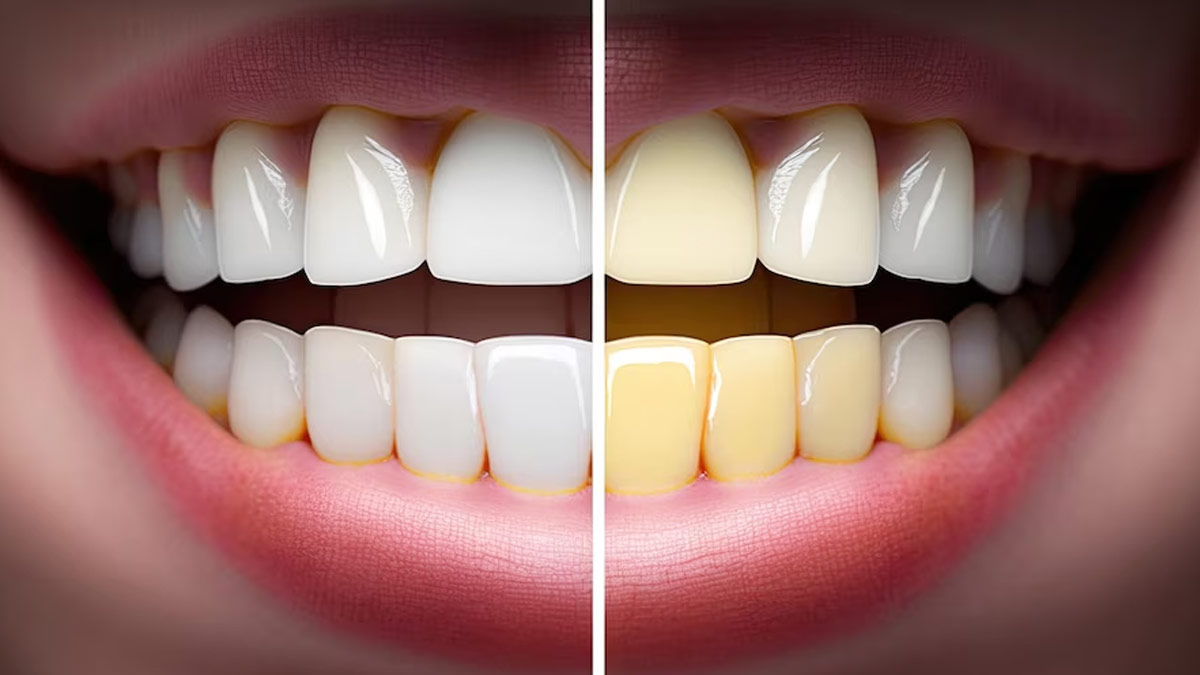 Teeth Whitening: பற்களில் மஞ்சள் கறையை போக்கும் ஈஸியான வழிமுறைகள்!