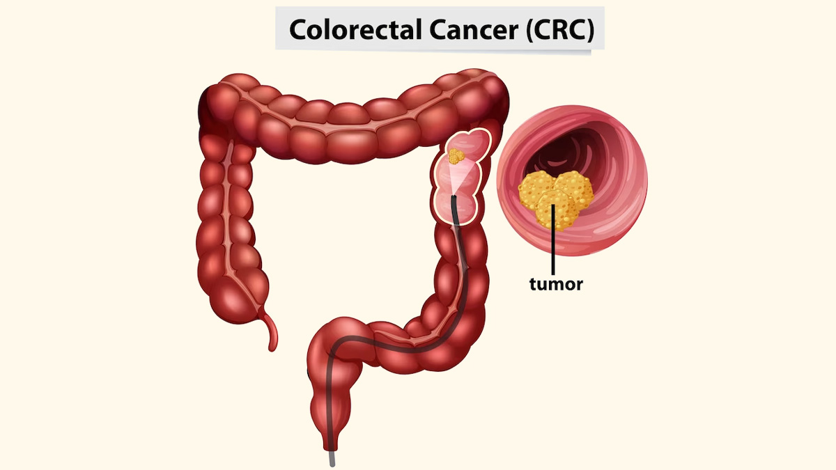 Rectal Cancer: மலக்குடல் புற்றுநோயின் அறிகுறி, காரணம் மற்றும் சிகிச்சை