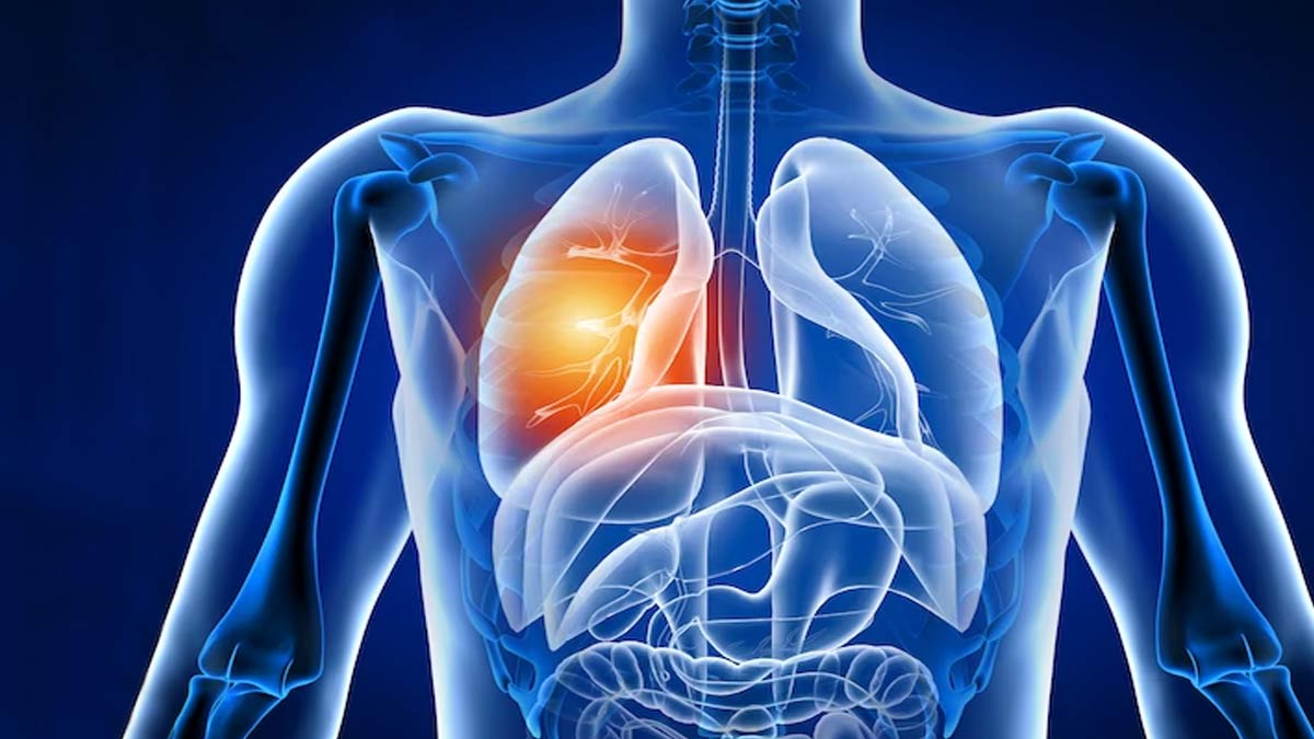 Lung Cancer Types: நுரையீரல் புற்றுநோயின் வகைகளும், சிகிச்சை முறைகளும்