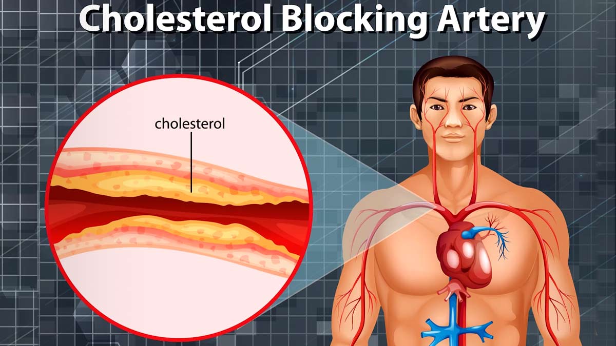 Cholesterol Signs: இந்த அறிகுறிகள் இருந்தா உங்க உடம்புல கெட்ட கொலஸ்டிரால் அதிகமா இருக்குனு அர்த்தம்!