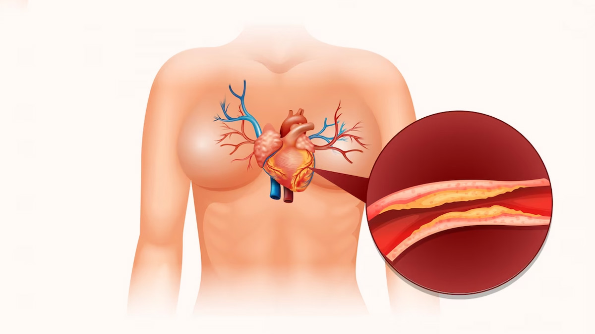 Cholesterol Types: கொலஸ்ட்ரால் வகைகள் என்னென்ன? அதை எப்படி குறைப்பது?