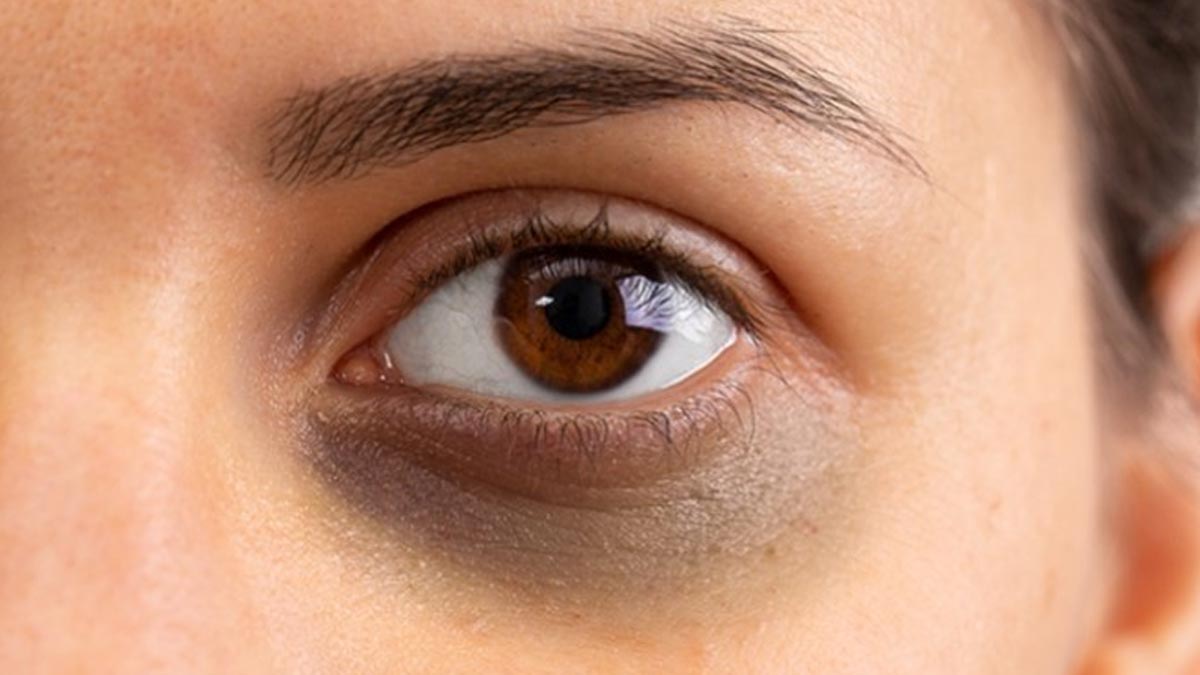 Eye Dark Circles: கண்களுக்கு கீழே கருவளையம் வர காரணம் என்ன? தீர்வு இதோ!