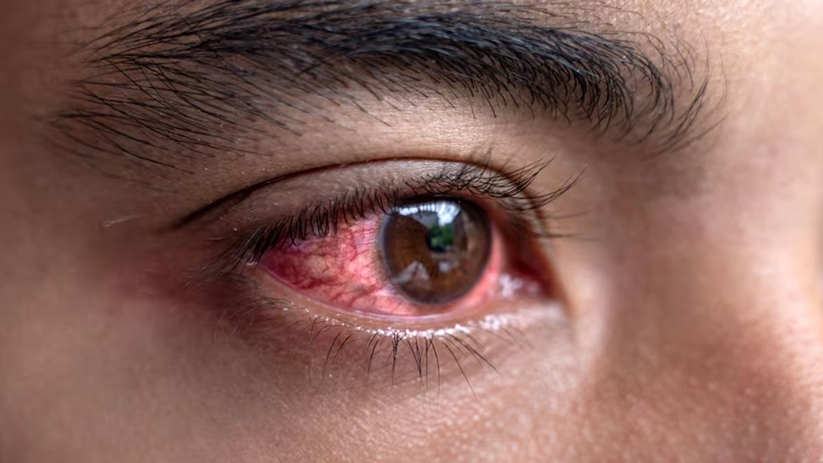 Eye Redness Reasons: கண்கள் சிவப்பாக மாற காரணமும், அதற்கான தீர்வையும் பார்க்கலாம்!